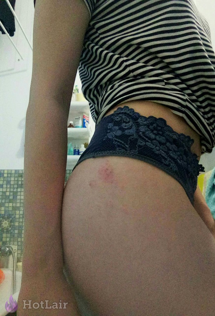 Gros plan de la fesse d’une femme avec marque rouge sur la peau en culotte dentelle bleu foncé sous t-shirt rayé relevé dans une salle de bain